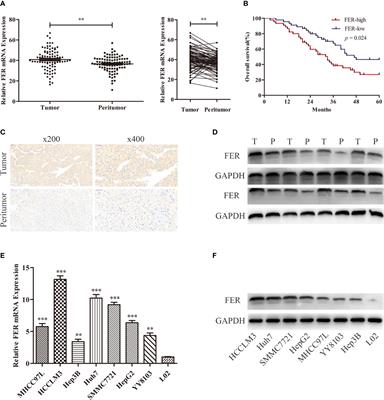 FER Regulated by miR-206 Promotes Hepatocellular Carcinoma Progression via NF-κB Signaling